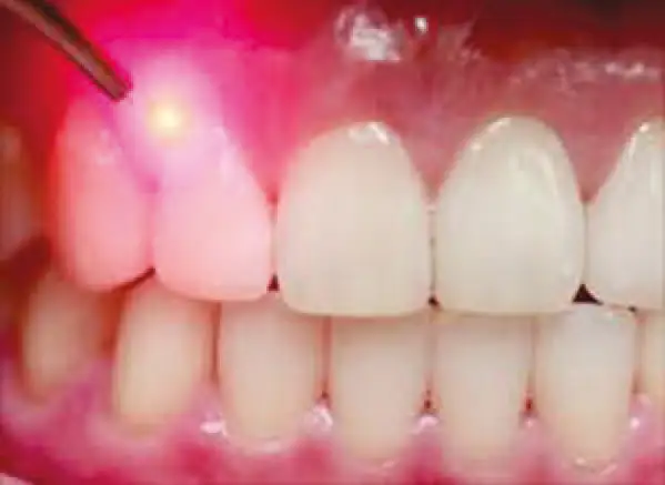 articolo laser2