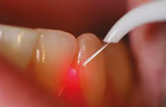 articolo laser3
