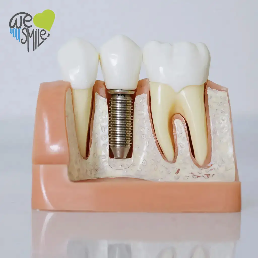 Impianti in titanio e osteointegrazione