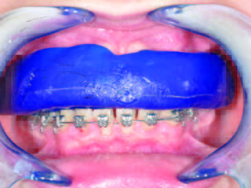 traumi dentali