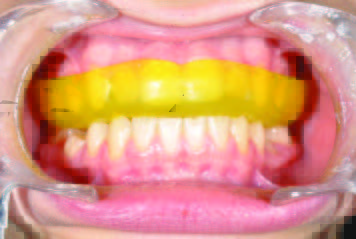 articolo traumi dentali 2